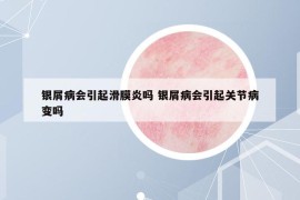 银屑病会引起滑膜炎吗 银屑病会引起关节病变吗