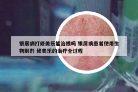 银屑病打修美乐能治根吗 银屑病患者使用生物制剂 修美乐的治疗全过程