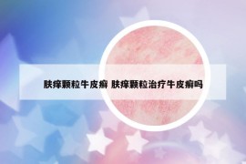 肤痒颗粒牛皮癣 肤痒颗粒治疗牛皮癣吗