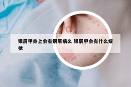 银屑甲身上会有银屑病么 银屑甲会有什么症状