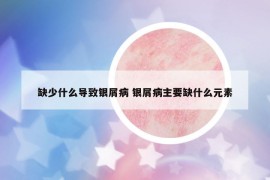 缺少什么导致银屑病 银屑病主要缺什么元素