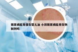 银屑病能用强生婴儿油 小孩银屑病能用生物制剂吗