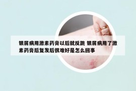 银屑病用激素药膏以后就反跳 银屑病用了激素药膏后复发后很难好是怎么回事