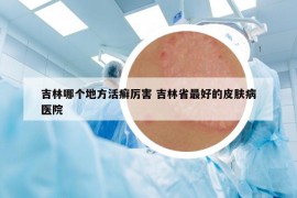 吉林哪个地方活癣厉害 吉林省最好的皮肤病医院