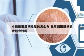 小孩副银屑病反复长怎么办 儿童副银屑病长大后会好吗