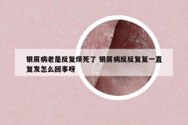 银屑病老是反复烦死了 银屑病反反复复一直复发怎么回事呀