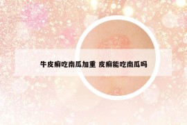 牛皮癣吃南瓜加重 皮癣能吃南瓜吗