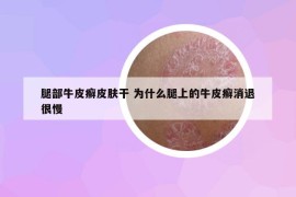 腿部牛皮癣皮肤干 为什么腿上的牛皮癣消退很慢