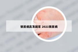 银屑病高发国家 2021银屑病