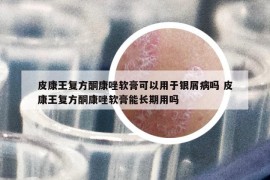 皮康王复方酮康唑软膏可以用于银屑病吗 皮康王复方酮康唑软膏能长期用吗