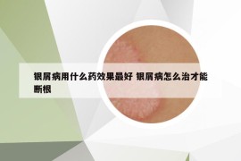 银屑病用什么药效果最好 银屑病怎么治才能断根