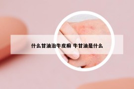 什么甘油治牛皮癣 牛甘油是什么