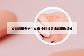 安阳哪里专治牛皮癣 安阳银屑病哪里治得好