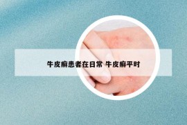 牛皮癣患者在日常 牛皮癣平时