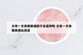 父母一方有银屑病孩子会遗传吗 父亲一方有银屑病女孩会