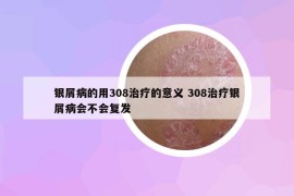 银屑病的用308治疗的意义 308治疗银屑病会不会复发