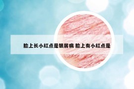 脸上长小红点是银屑病 脸上有小红点是