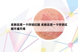 皮肤出现一个环状红圈 皮肤出现一个环状红圈不痛不痒