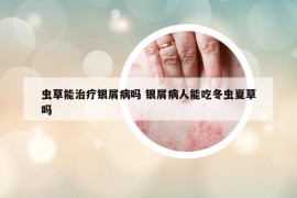 虫草能治疗银屑病吗 银屑病人能吃冬虫夏草吗