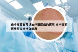 南宁哪里有可以治疗银屑病的医院 南宁哪家医院可以治疗白癜风