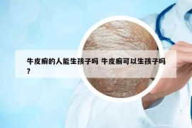 牛皮癣的人能生孩子吗 牛皮癣可以生孩子吗?
