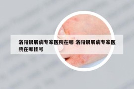 洛阳银屑病专家医院在哪 洛阳银屑病专家医院在哪挂号