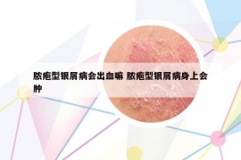 脓疱型银屑病会出血嘛 脓疱型银屑病身上会肿
