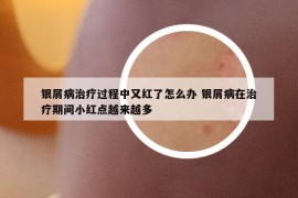 银屑病治疗过程中又红了怎么办 银屑病在治疗期间小红点越来越多