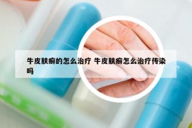 牛皮肤癣的怎么治疗 牛皮肤癣怎么治疗传染吗