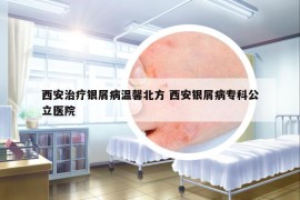 西安治疗银屑病温馨北方 西安银屑病专科公立医院
