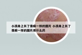 小孩身上长了像癣一样的图片 小孩身上长了像癣一样的图片用什么药