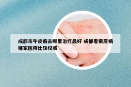 成都市牛皮癣去哪里治疗最好 成都看银屑病哪家医院比较权威