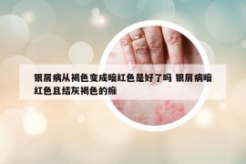 银屑病从褐色变成暗红色是好了吗 银屑病暗红色且结灰褐色的痂