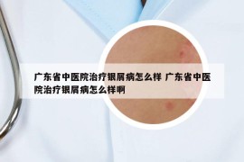 广东省中医院治疗银屑病怎么样 广东省中医院治疗银屑病怎么样啊