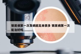 银屑病第一次发病就出来很多 银屑病第一次能治好吗