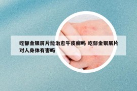 吃郁金银屑片能治愈牛皮癣吗 吃郁金银屑片对人身体有害吗