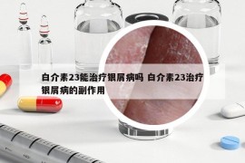 白介素23能治疗银屑病吗 白介素23治疗银屑病的副作用
