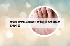 西安哪里看银屑病最好 西安最厉害看银屑病的老中医