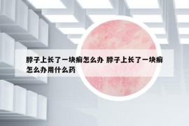 脖子上长了一块癣怎么办 脖子上长了一块癣怎么办用什么药