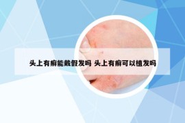头上有癣能戴假发吗 头上有癣可以植发吗