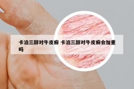 卡泊三醇对牛皮癣 卡泊三醇对牛皮癣会加重吗