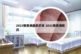 2023银屑病最新药膏 2021银屑病新药