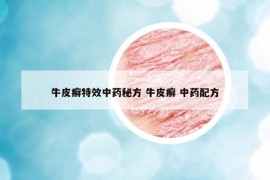 牛皮癣特效中药秘方 牛皮癣 中药配方