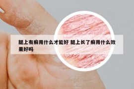 腿上有癣用什么才能好 腿上长了癣用什么效果好吗