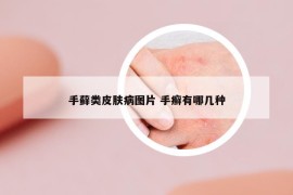 手藓类皮肤病图片 手癣有哪几种