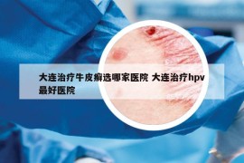 大连治疗牛皮癣选哪家医院 大连治疗hpv最好医院
