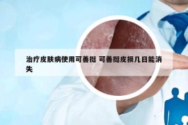 治疗皮肤病使用可善挺 可善挺皮损几日能消失