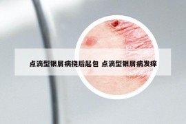 点滴型银屑病挠后起包 点滴型银屑病发痒