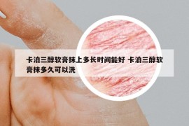 卡泊三醇软膏抹上多长时间能好 卡泊三醇软膏抹多久可以洗
