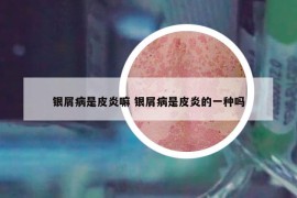 银屑病是皮炎嘛 银屑病是皮炎的一种吗